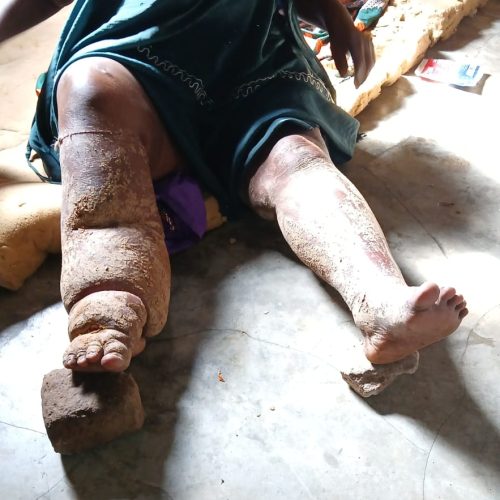 Mãe de seis filhos no Kilamba-Kiaxi lança grito de socorro após 11 anos de enfermidade